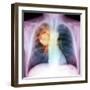 Lung Cancer, X-ray-Du Cane Medical-Framed Premium Photographic Print