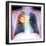 Lung Cancer, X-ray-Du Cane Medical-Framed Premium Photographic Print