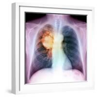 Lung Cancer, X-ray-Du Cane Medical-Framed Premium Photographic Print