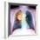 Lung Cancer, X-ray-Du Cane Medical-Framed Premium Photographic Print