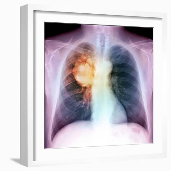 Lung Cancer, X-ray-Du Cane Medical-Framed Premium Photographic Print