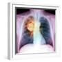 Lung Cancer, X-ray-Du Cane Medical-Framed Premium Photographic Print