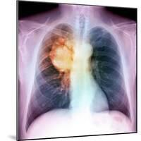 Lung Cancer, X-ray-Du Cane Medical-Mounted Premium Photographic Print