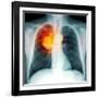 Lung Cancer, X-ray-Du Cane Medical-Framed Photographic Print