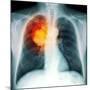 Lung Cancer, X-ray-Du Cane Medical-Mounted Photographic Print