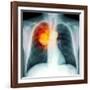 Lung Cancer, X-ray-Du Cane Medical-Framed Photographic Print