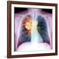 Lung Cancer, X-ray-Du Cane Medical-Framed Photographic Print