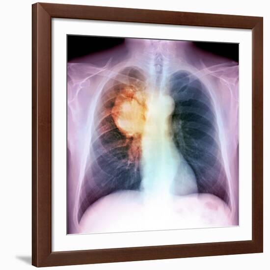 Lung Cancer, X-ray-Du Cane Medical-Framed Photographic Print