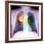 Lung Cancer, X-ray-Du Cane Medical-Framed Photographic Print