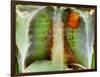 Lung Cancer, X-ray-Du Cane Medical-Framed Photographic Print