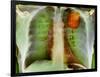 Lung Cancer, X-ray-Du Cane Medical-Framed Photographic Print