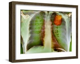 Lung Cancer, X-ray-Du Cane Medical-Framed Photographic Print