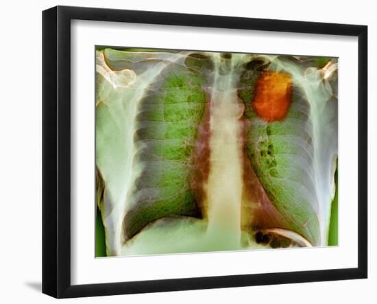 Lung Cancer, X-ray-Du Cane Medical-Framed Photographic Print