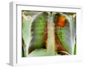 Lung Cancer, X-ray-Du Cane Medical-Framed Photographic Print