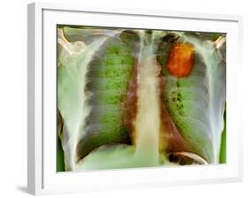 Lung Cancer, X-ray-Du Cane Medical-Framed Photographic Print