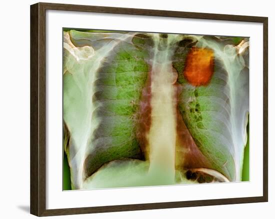 Lung Cancer, X-ray-Du Cane Medical-Framed Photographic Print