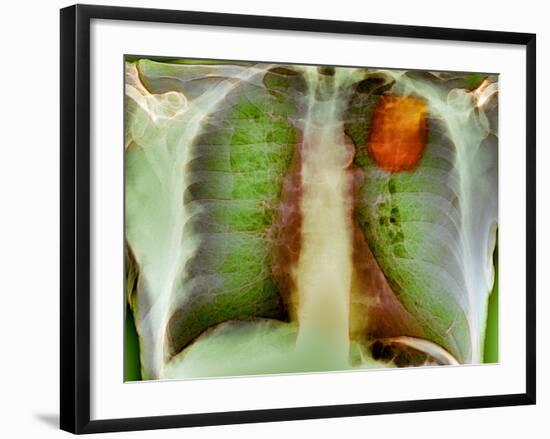 Lung Cancer, X-ray-Du Cane Medical-Framed Photographic Print