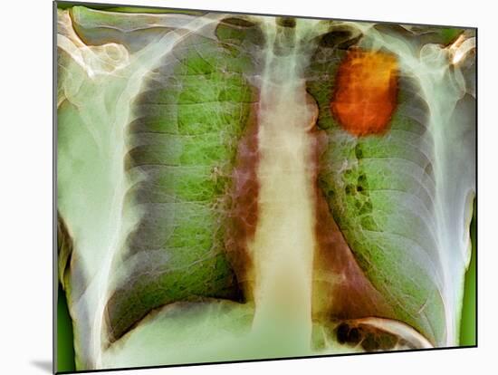 Lung Cancer, X-ray-Du Cane Medical-Mounted Photographic Print