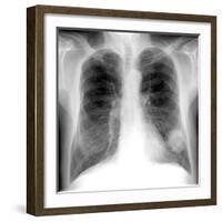 Lung Cancer, X-ray-Du Cane Medical-Framed Photographic Print