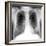 Lung Cancer, X-ray-Du Cane Medical-Framed Photographic Print