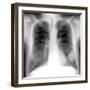 Lung Cancer, X-ray-Du Cane Medical-Framed Photographic Print