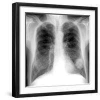 Lung Cancer, X-ray-Du Cane Medical-Framed Photographic Print