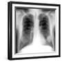 Lung Cancer, X-ray-Du Cane Medical-Framed Photographic Print