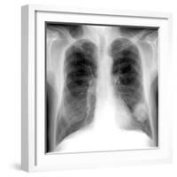 Lung Cancer, X-ray-Du Cane Medical-Framed Photographic Print