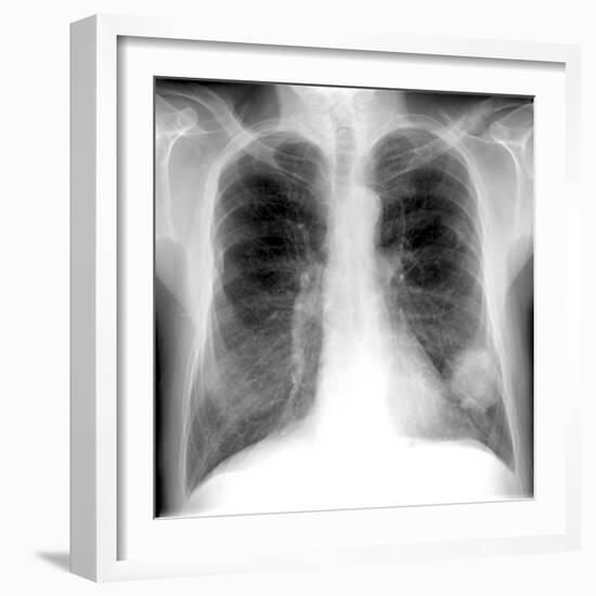 Lung Cancer, X-ray-Du Cane Medical-Framed Photographic Print