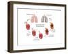 Lung Damage Leading to Emphysema-Monica Schroeder-Framed Art Print