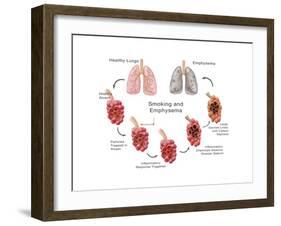 Lung Damage Leading to Emphysema-Monica Schroeder-Framed Art Print