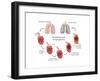 Lung Damage Leading to Emphysema-Monica Schroeder-Framed Art Print