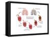 Lung Damage Leading to Emphysema-Monica Schroeder-Framed Stretched Canvas