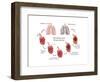 Lung Damage Leading to Emphysema-Monica Schroeder-Framed Art Print