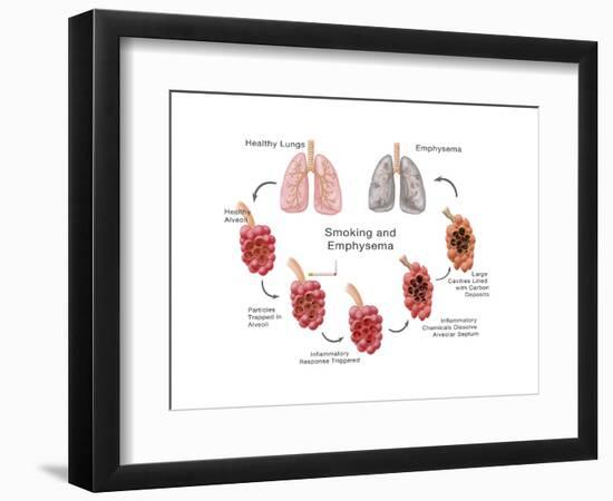 Lung Damage Leading to Emphysema-Monica Schroeder-Framed Art Print