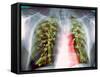 Lung Scarring From Tuberculosis, X-ray-Du Cane Medical-Framed Stretched Canvas