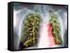 Lung Scarring From Tuberculosis, X-ray-Du Cane Medical-Framed Stretched Canvas