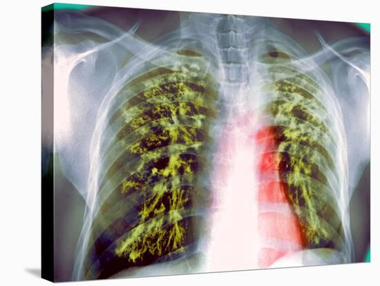 Lung Scarring From Tuberculosis, X-ray-Du Cane Medical-Stretched Canvas