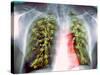 Lung Scarring From Tuberculosis, X-ray-Du Cane Medical-Stretched Canvas