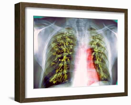 Lung Scarring From Tuberculosis, X-ray-Du Cane Medical-Framed Photographic Print