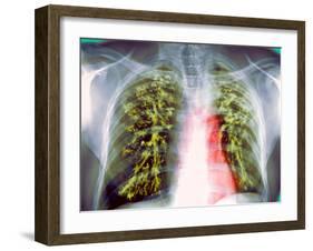 Lung Scarring From Tuberculosis, X-ray-Du Cane Medical-Framed Photographic Print