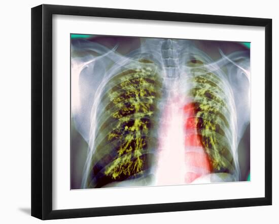 Lung Scarring From Tuberculosis, X-ray-Du Cane Medical-Framed Photographic Print