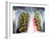 Lung Scarring From Tuberculosis, X-ray-Du Cane Medical-Framed Photographic Print