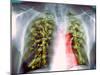 Lung Scarring From Tuberculosis, X-ray-Du Cane Medical-Mounted Photographic Print