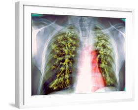 Lung Scarring From Tuberculosis, X-ray-Du Cane Medical-Framed Photographic Print