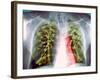 Lung Scarring From Tuberculosis, X-ray-Du Cane Medical-Framed Photographic Print