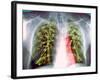 Lung Scarring From Tuberculosis, X-ray-Du Cane Medical-Framed Photographic Print