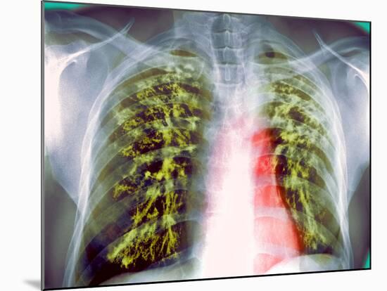 Lung Scarring From Tuberculosis, X-ray-Du Cane Medical-Mounted Photographic Print