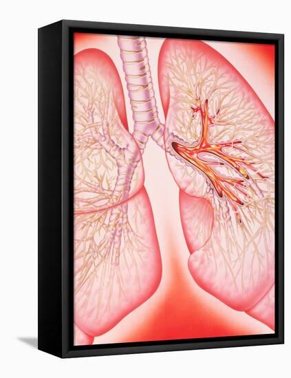 Lungs with Bronchitis-John Bavosi-Framed Stretched Canvas