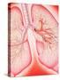 Lungs with Bronchitis-John Bavosi-Stretched Canvas